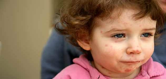 أعراض الجدري عند الأطفال وكيفية علاجه