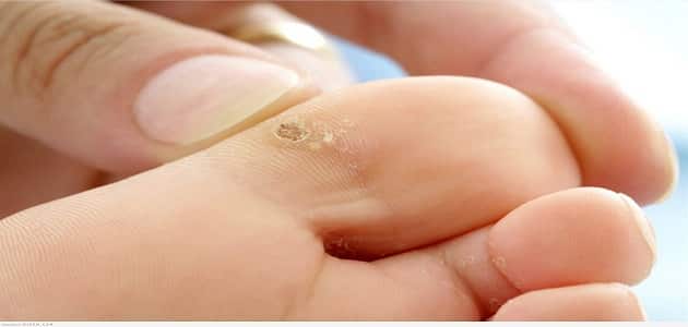 علاج مسمار القدم عند الأطفال