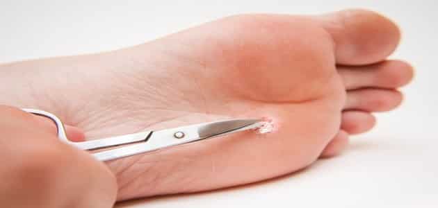 علاج مسمار القدم عند الأطفال