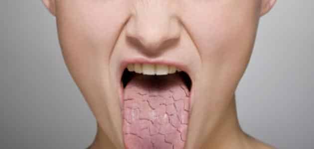 أسباب اصفرار اللسان والرائحة الكريهة وكيفية علاجها في أسبوع