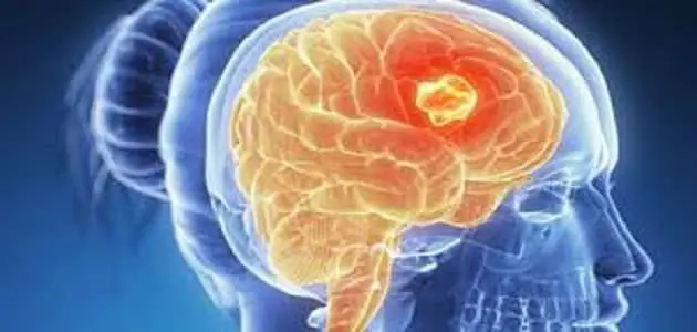أعراض سرطان المخ المتقدم ومراحله