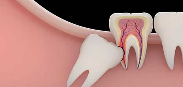 أعراض ظهور ضرس العقل وكيفية علاجه