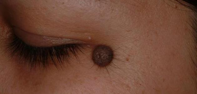 ازالة حب الخال طبيعيا بزيت الخروع بدون ليزر