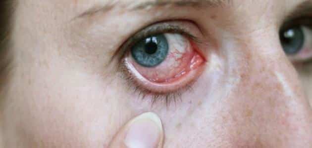 عراض ضعف شبكية العين وعلاجه
