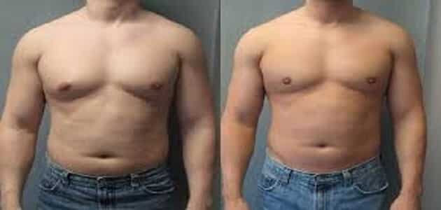 علاج التثدي عند الرجال بالأعشاب والكركم