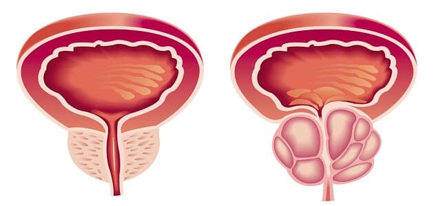 علاج التهاب المثانة بطرق طبيعية