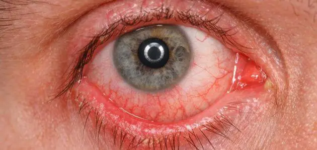 علاج التهاب ملتحمة بياض العين المزمن بالصور