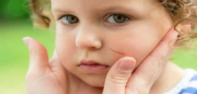 علاج خدوش الوجه بالأظافر للأطفال