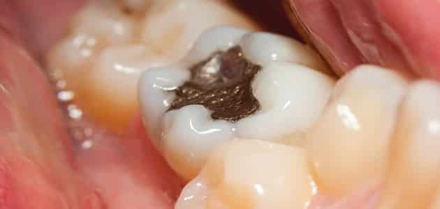 أنواع حشوات الأسنان الدائمة والمتحركة وطريقة تركيبها بالصور