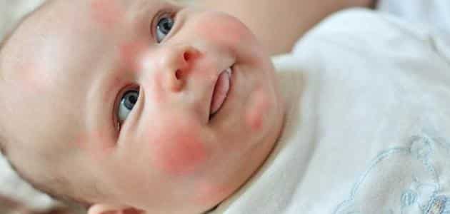اعراض حساسية البيض المسلوق