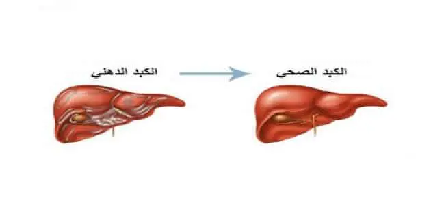 الكبد الدهني