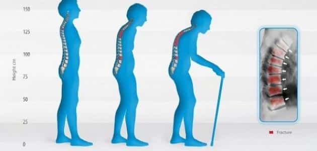 علاج نهائي لانحداب وتقوس الظهر بعد سن 18