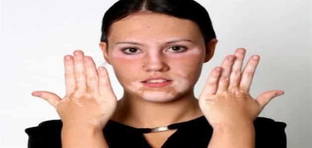 مرض البرص