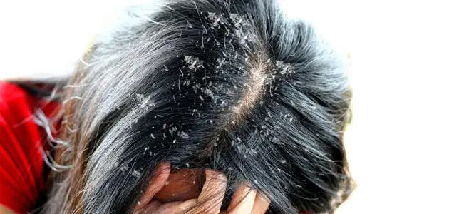 أسباب انتشار القشور على جذوع الشعر