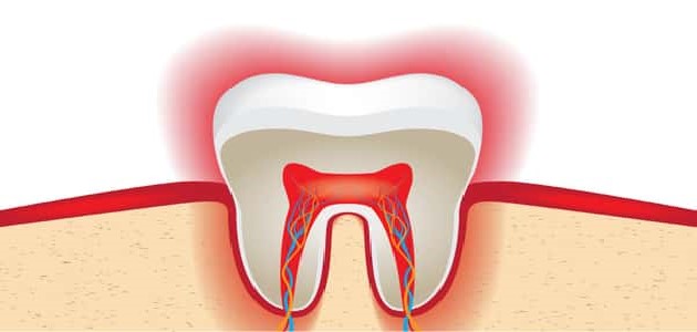 ألم عصب الأسنان