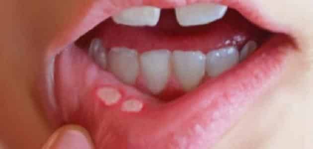 كيفية استخدام جل دكتارين للفم للاطفال الصغار