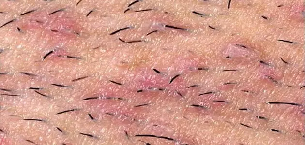 علاج التهاب بصيلات الشعر في المنطقة الحساسة بالأعشاب