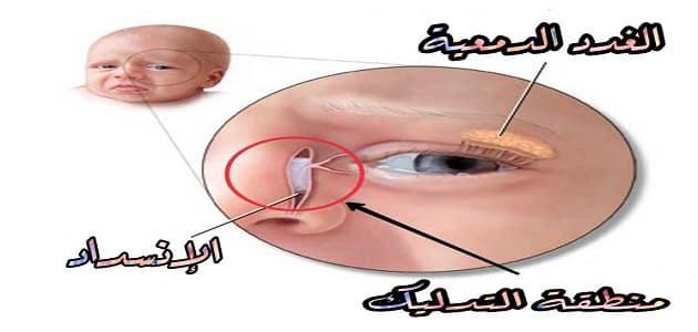 علاج انسداد القناة الدمعية عند الكبار في 3 ايام