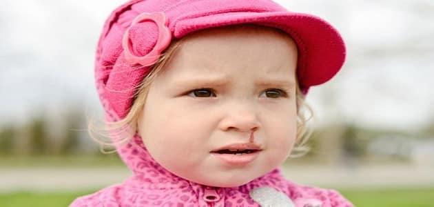 علاج نزيف الأنف المستمر عند الأطفال بالاعشاب