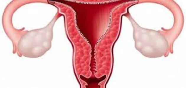 طرق علاج سماكة بطانة الرحم بالأعشاب