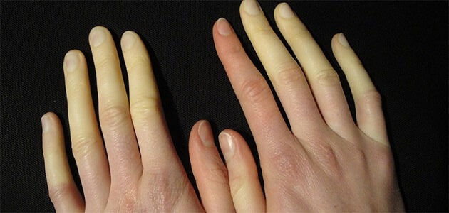 علاج تورم الاصابع وازالة اللون الازرق في الشتاء