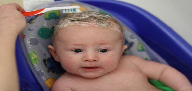 قشرة رأس المواليد