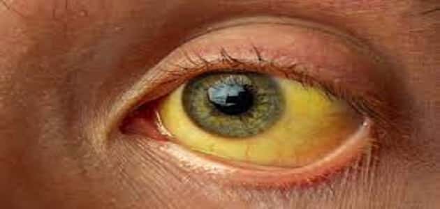 درجات اصفرار العين وطرق علاجها