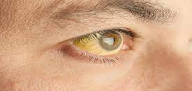 علاج اصفرار العين الغير مرضي