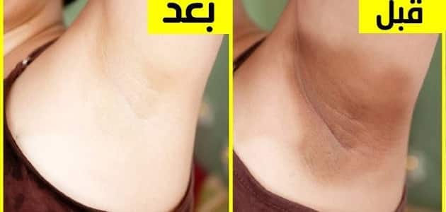 تفتيح المناطق الحساسة بالتقشير الكيميائي